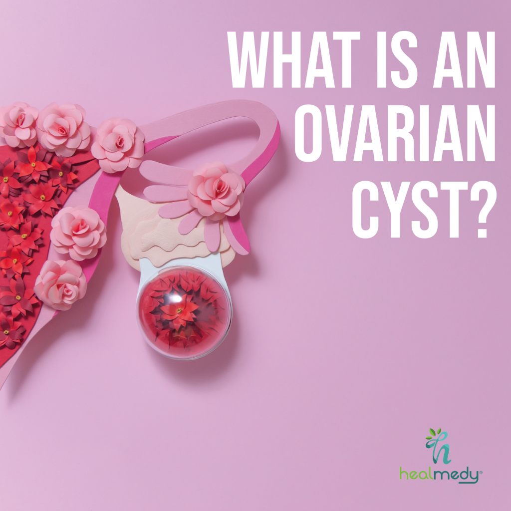 what-is-an-ovarian-cyst-healtcare-consulting-services-solutions