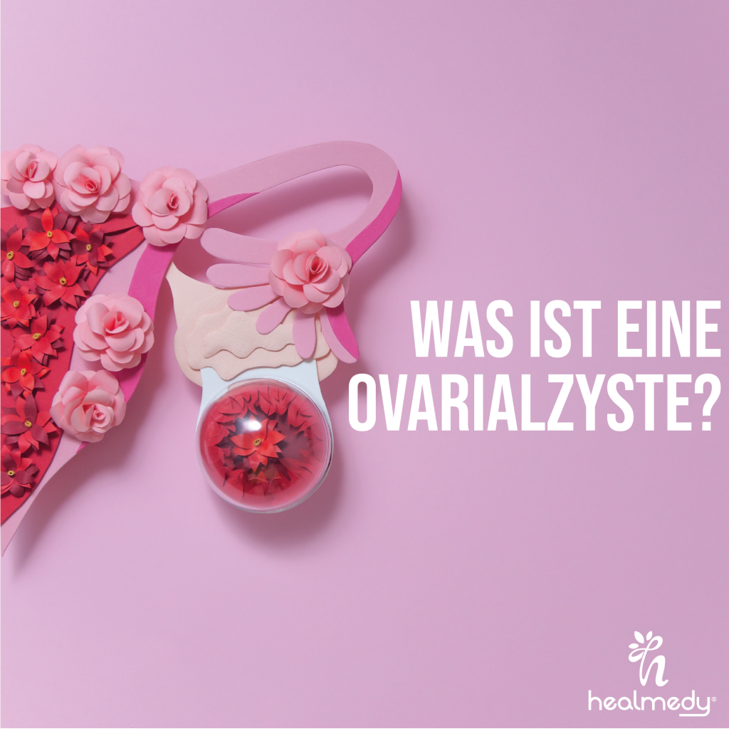 WAS IST EINE OVARIALZYSTE? GESUNDHEITSBERATUNG UND MANAGEMENT